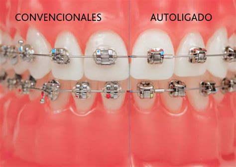 brackets autoligados metalicos|autoligado vs brackets convencionales.